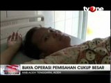 Bayi Kembar Siam Dempet Kepala Lahir di RS H  Sahudin Aceh