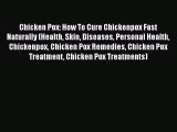 Read Chicken Pox: How To Cure Chickenpox Fast Naturally (Health Skin Diseases Personal Health