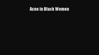 Read Acne in Black Women Ebook Free
