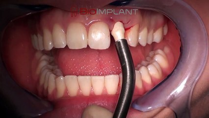 IMMEDIATE CERAMIC IMPLANT LATERAL INCISOR NON SURGICAL