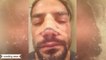 Roman Reigns undergoes surgery following Triple H attack 25 February 2016