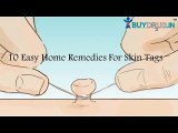 10 Home Remedies For Skin Tags