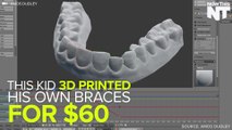 Students Designs And 3D Prints His Own Braces