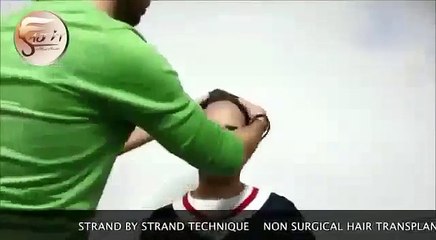 Non Surgical Hair Replacement