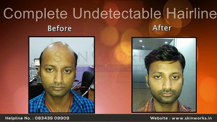 Non surgical hair replacement in India