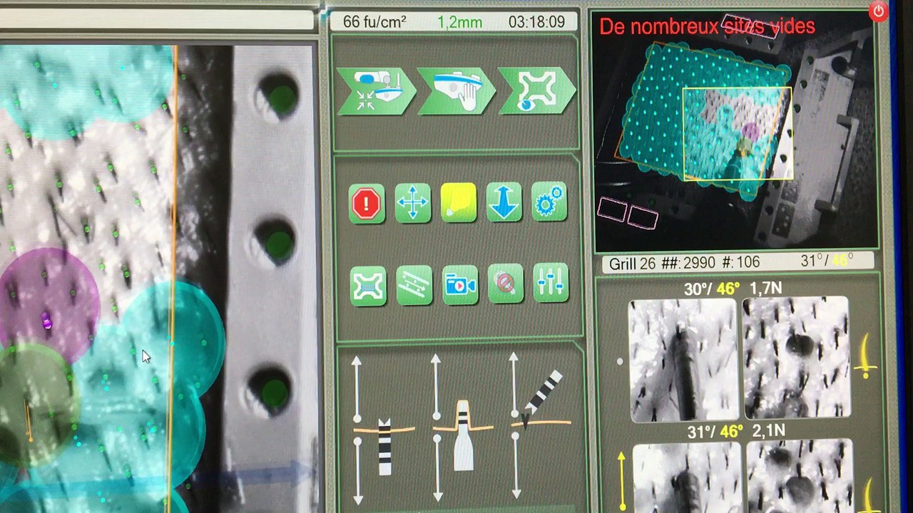 3000 greffons prélevés en 3h18 mn