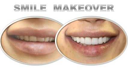 Before and After Ceramic Veneers Dubai +97143955660