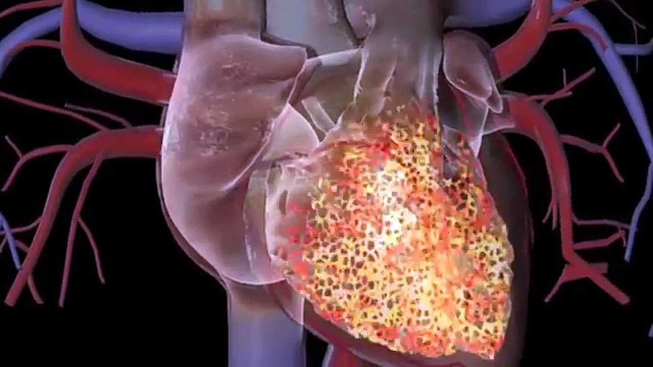 Pacemaker procedure .