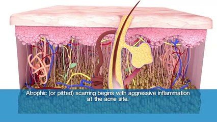 Bellafill® for Acne Scar Proposed Mechanism of Action
