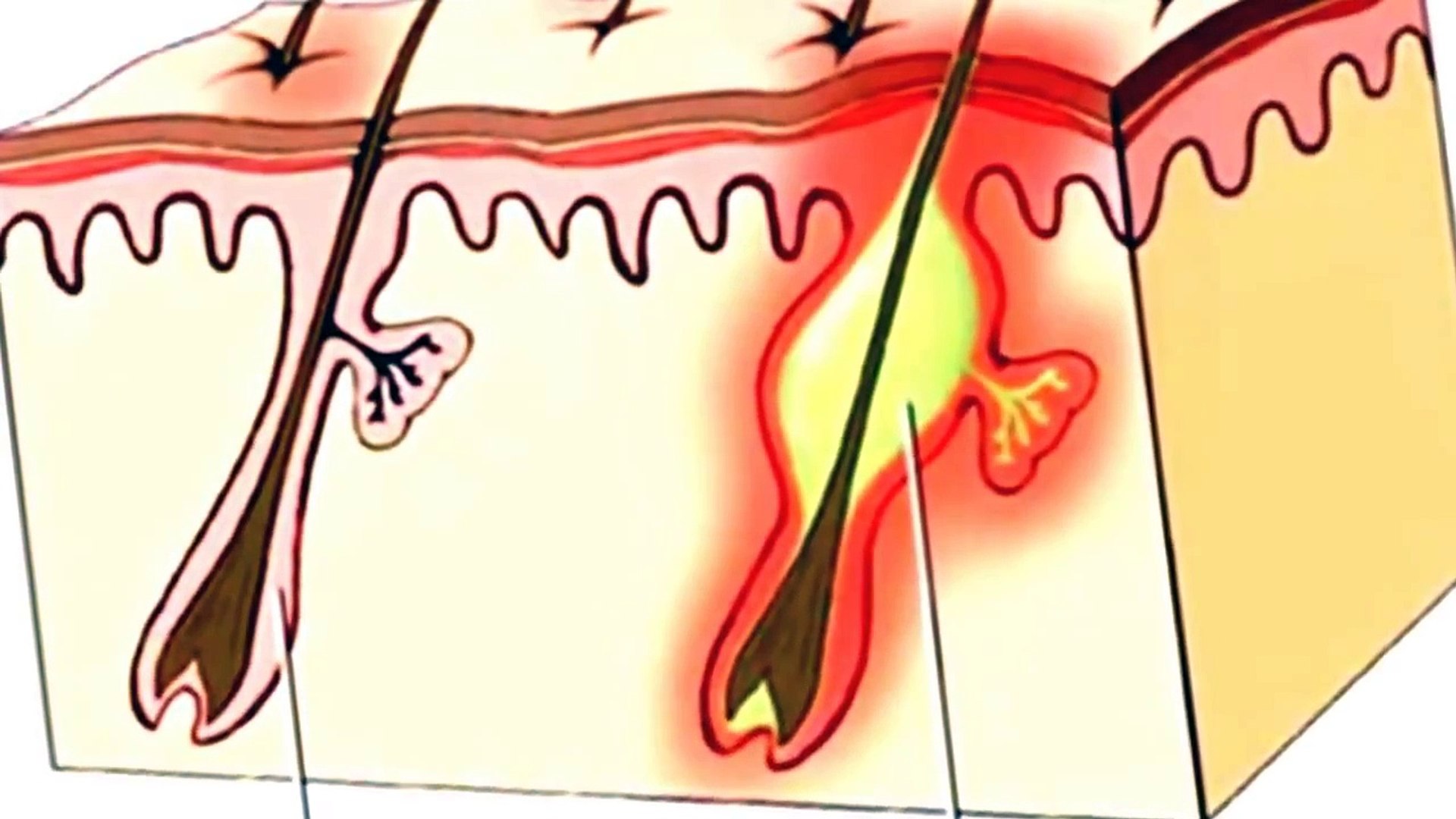 What Is A Carbuncle World39s Largest Cysts Lancing A Diagnosis,