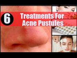 Watch 6 Treatments For Acne Pustules - Pustule Treatment