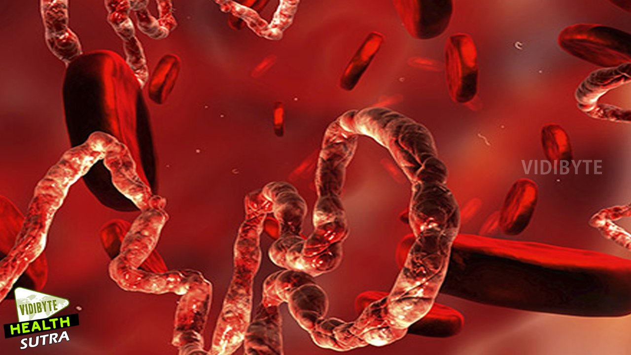 Ebola Virus Symptoms, Treatment, and Prevention || Health Tips