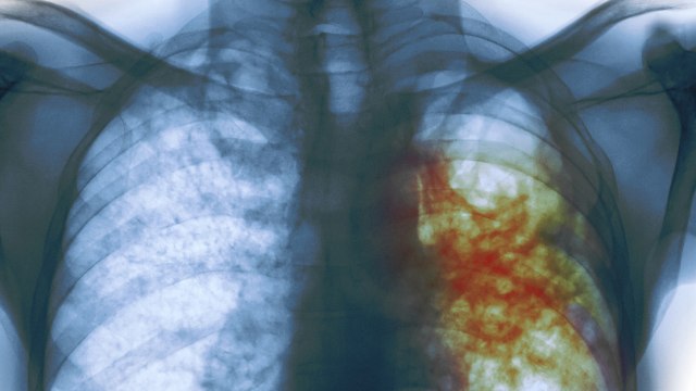 Tuberculosis Symptoms and Causes || Health Tips