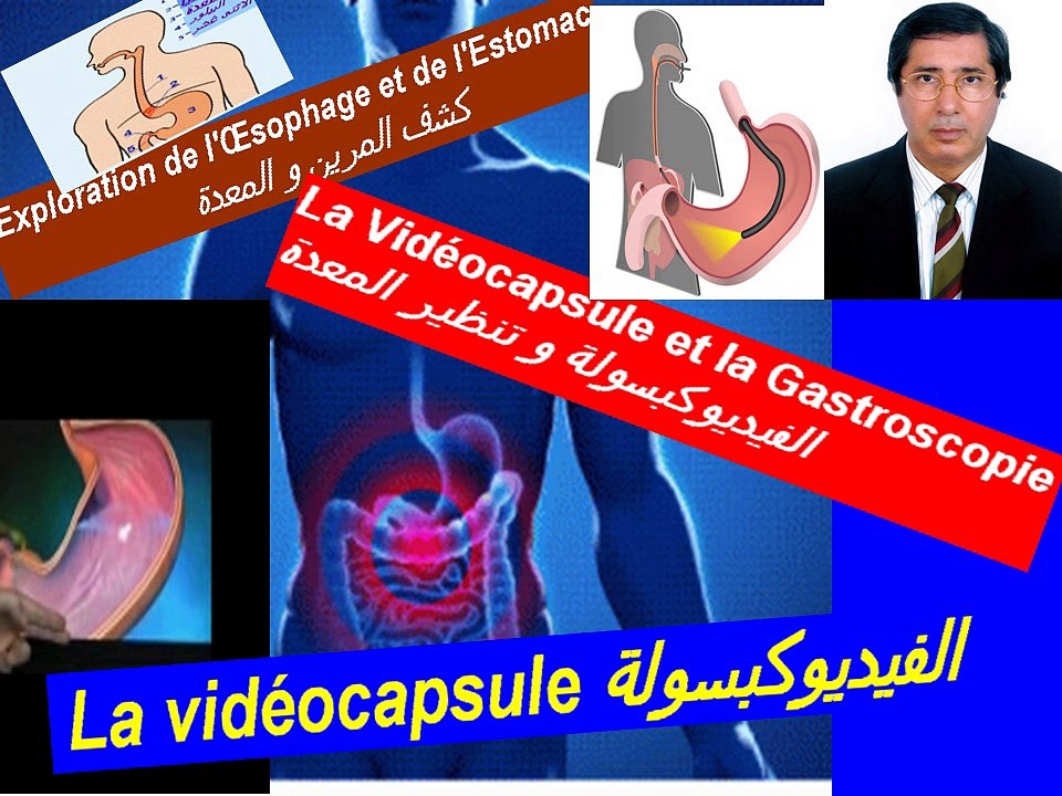videocapsule et gastroscopie