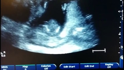 Малыш на УЗИ хлопает в ладоши