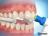 Quy trình niềng răng thẩm mỹ chuẩn quốc tế