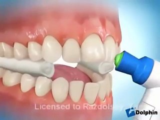 Quy trình niềng răng thẩm mỹ chuẩn quốc tế