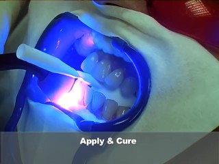Quy trình tẩy trắng răng bằng công nghệ Brite Smile
