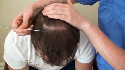 5319 FUT Hattingen Hair Transplantation Switzerland