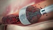 Heart Stent video (Angioplasty)