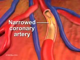 What is ANGIOPLASTY and STENTING-