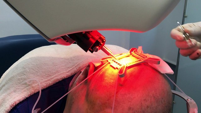 Video de prelevement ARTAS