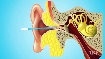 Perchè i cotton fioc sono dannosi per la pulizia delle orecchie.