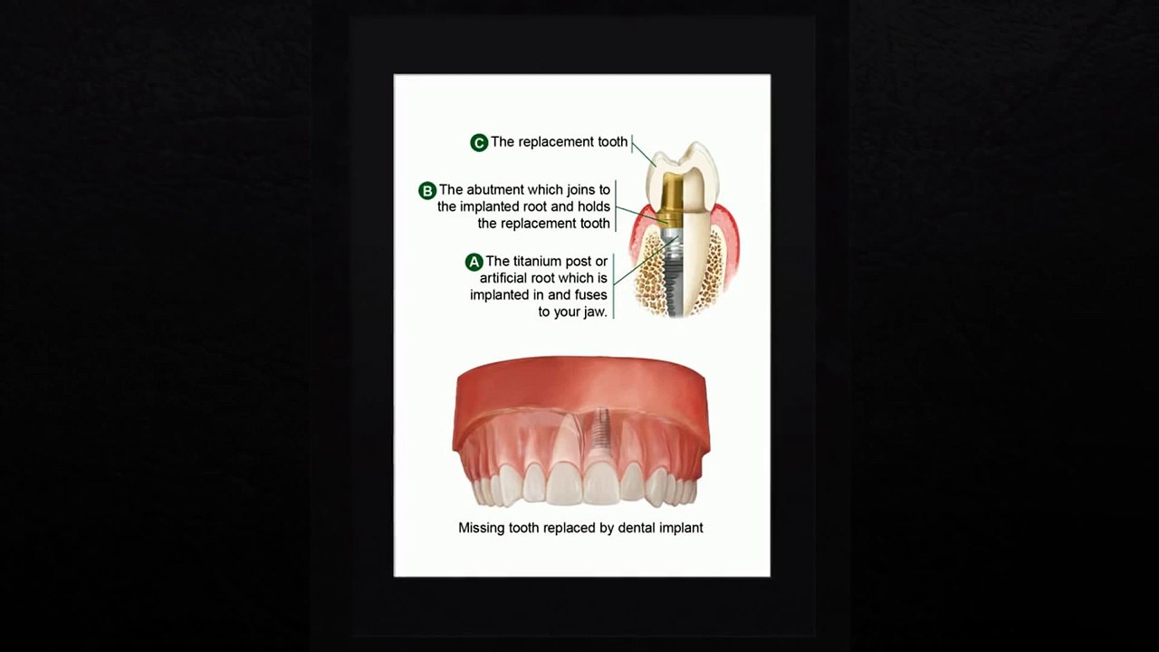 Dental Implants Austin TX | Call Us: (512)379-5752