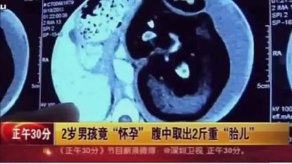 Bimbo di 2 anni partorisce il gemello