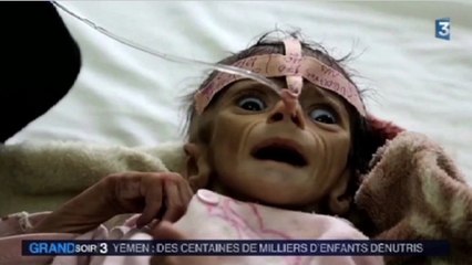 Zapping du 31 mars 2016 - Yemen : Scandale humanitaire !