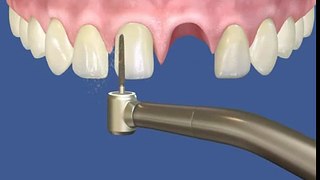 Протезирование зубов - один из видов востановления