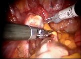 Robotic Lysis of Adhesion and Excision of Endometrosis