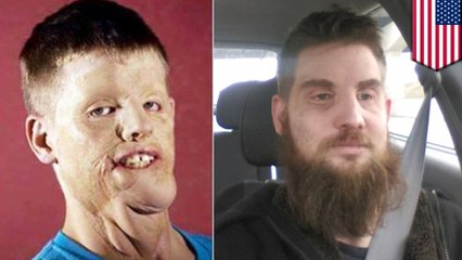 Full face transplant recipient Mitch Hunter is now ready for his close up