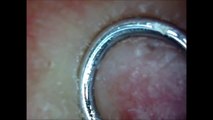 blackhead extraction Squeezing blackheads and fine black hairs Blackhead Compilations