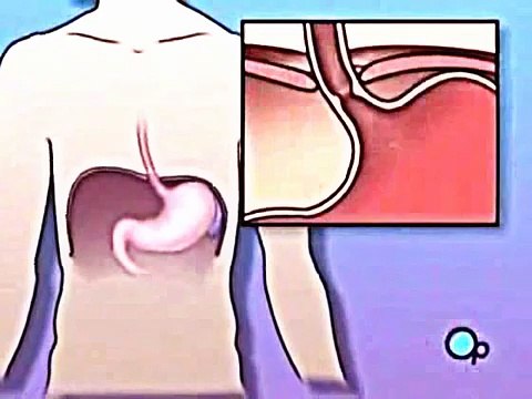 Medical Videos Hiatal Hernia 3D Medical Animation 2016