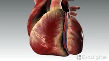 3D Medical Animation - What is a Heart Attack