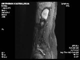 tumor cordoma condroide columna julia ontiveros castro