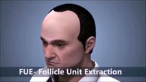 FUE -Follicle Extraction Unit , its woking process in details...