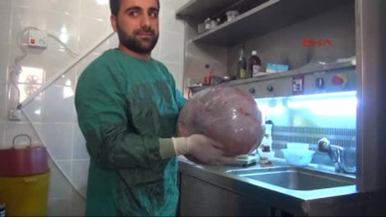 Batman Suriyeli 79 Yaşındaki Kadının Karnından 12 Kiloluk Kist Çıktı