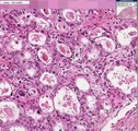 Histopathology Vagina--Clear cell carcinoma