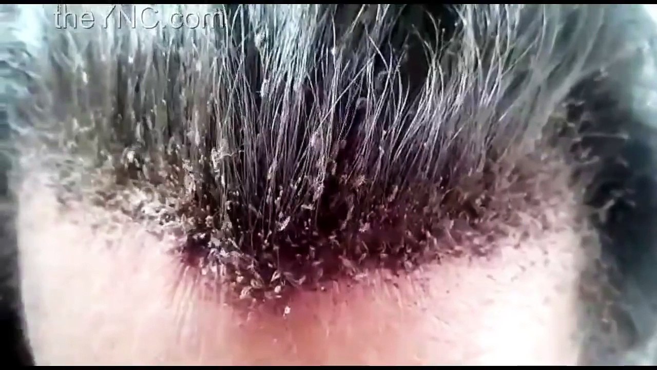 Amigo tiene la cabeza llena de piojos!