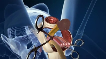 Une opération de changement de sexe (Homme vers femme) en 3D