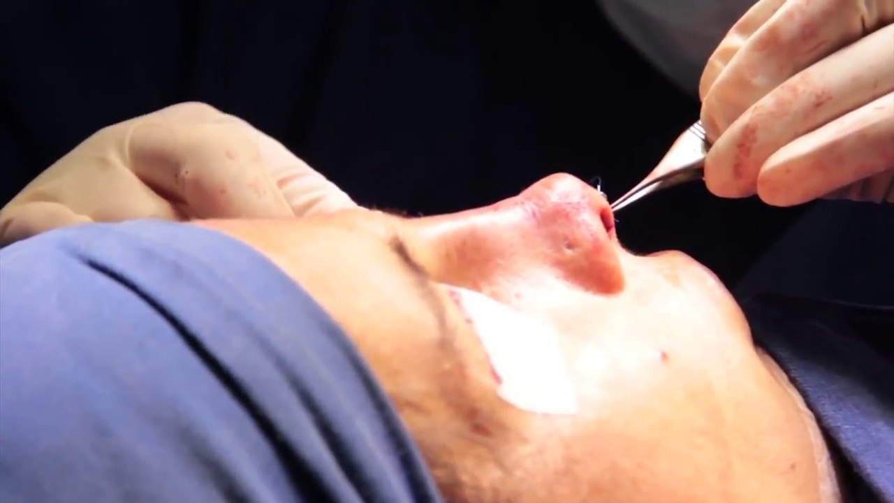 Rinoplastia Secundaria Abierta