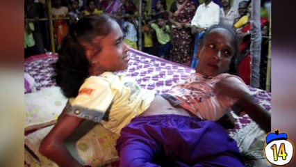 15 People with Extra Limbs & Body Parts