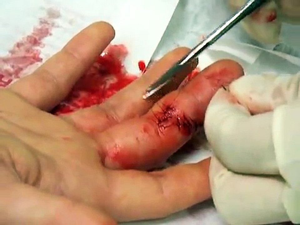 9 stitches