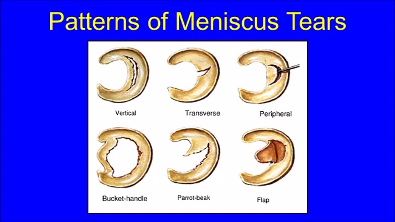 Partial Meniscectomy of a Bucket Handle Medial Meniscus Tear