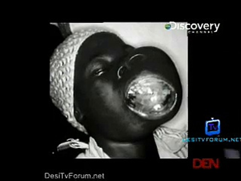 My Shocking Story (Face Eating Tumour) 8th December 2014 pt1