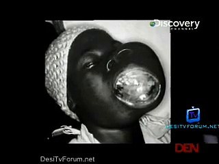 My Shocking Story (Face Eating Tumour) 8th December 2014 pt1