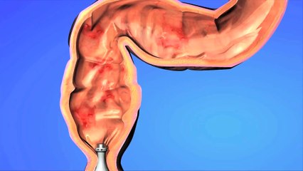 Ultrasound drug delivery