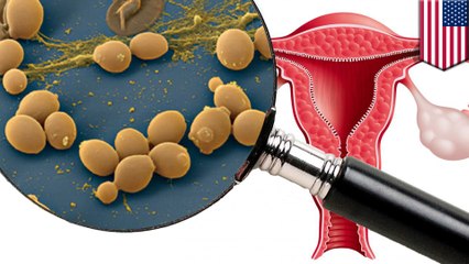 Common yeast infection botched up US doctors' first uterus transplant